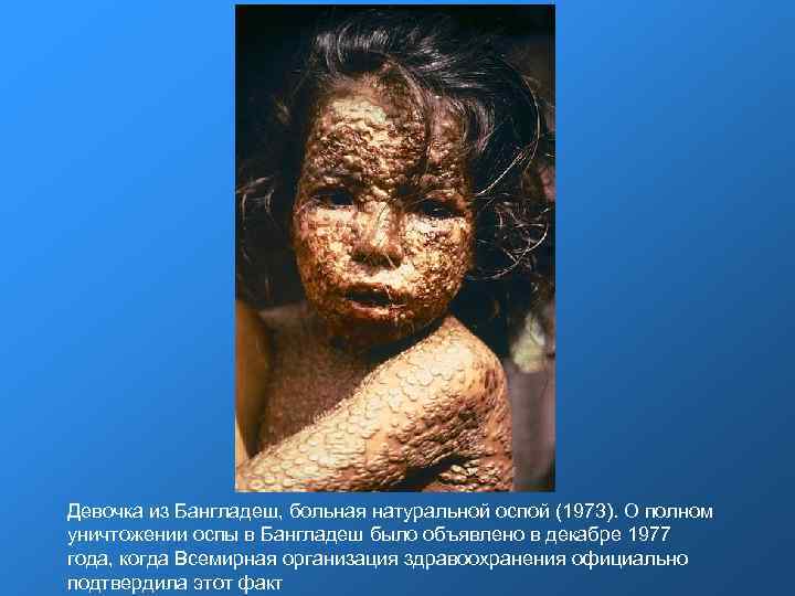 Девочка из Бангладеш, больная натуральной оспой (1973). О полном уничтожении оспы в Бангладеш было Девочка из Бангладеш, больная натуральной оспой (1973). О полном уничтожении оспы в Бангладеш было