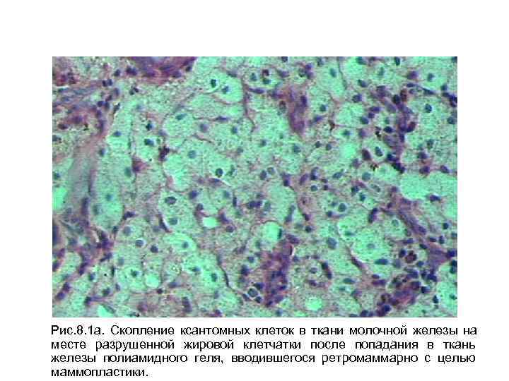 Рис. 8. 1 а. Скопление ксантомных клеток в ткани молочной железы на месте разрушенной