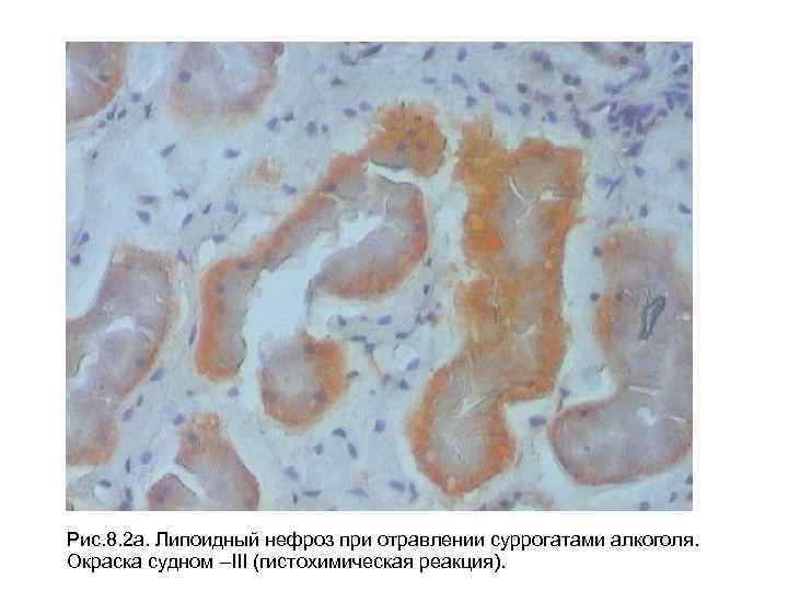 Рис. 8. 2 а. Липоидный нефроз при отравлении суррогатами алкоголя. Окраска судном –III (гистохимическая
