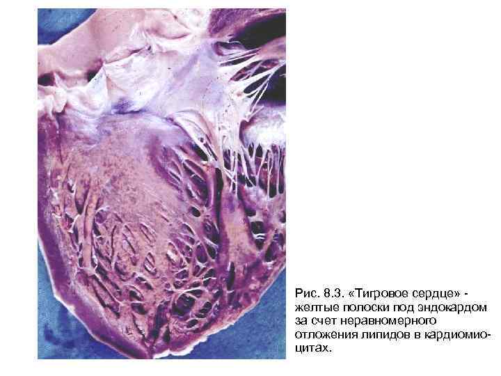 Рис. 8. 3.  «Тигровое сердце» - желтые полоски под эндокардом за счет неравномерного