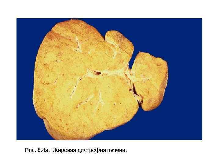Рис. 8. 4 а. Жировая дистрофия печени. 