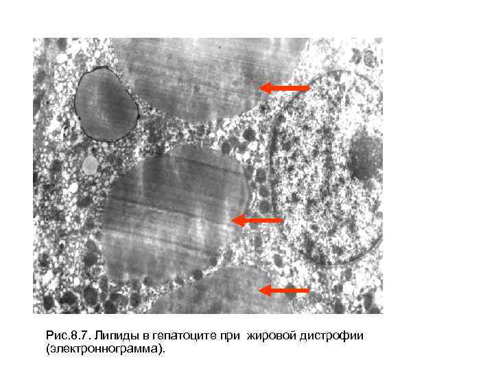 Рис. 8. 7. Липиды в гепатоците при жировой дистрофии (электроннограмма). 