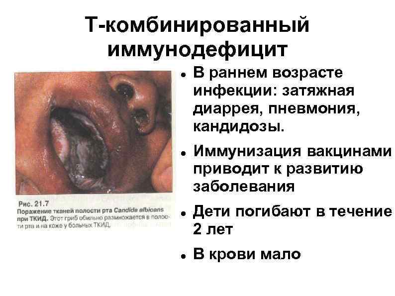 Т-комбинированный  иммунодефицит  В раннем возрасте  инфекции: затяжная  диаррея, пневмония, 