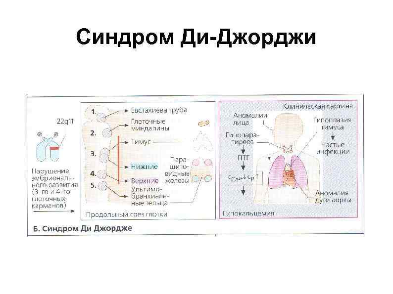 Синдром ди джорджи фото