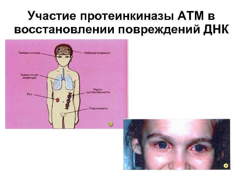  Участие протеинкиназы АТМ в восстановлении повреждений ДНК 