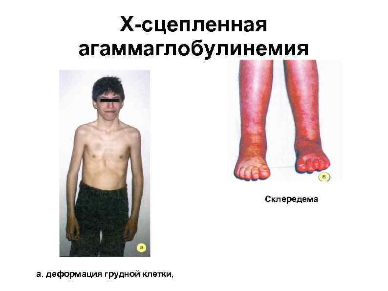   Х-сцепленная   агаммаглобулинемия       б. Склередема