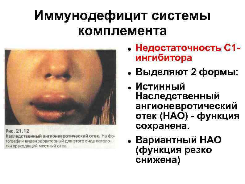 Иммунодефицит системы комплемента    Недостаточность С 1 -    ингибитора