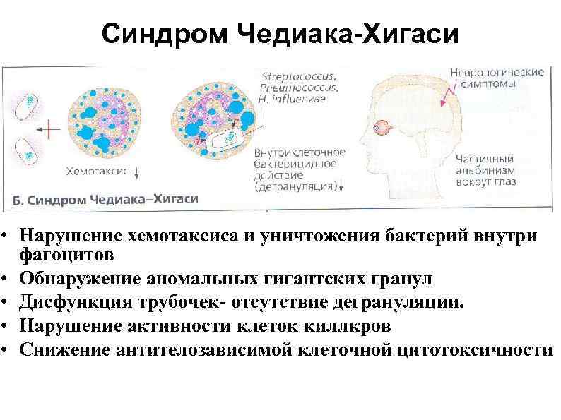   Синдром Чедиака-Хигаси • Нарушение хемотаксиса и уничтожения бактерий внутри  фагоцитов