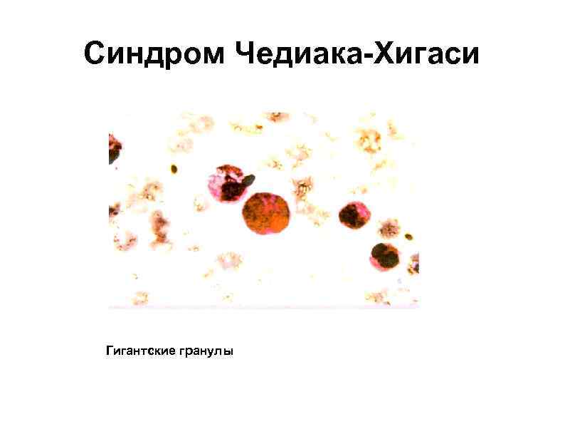 Синдром Чедиака-Хигаси Гигантские гранулы 