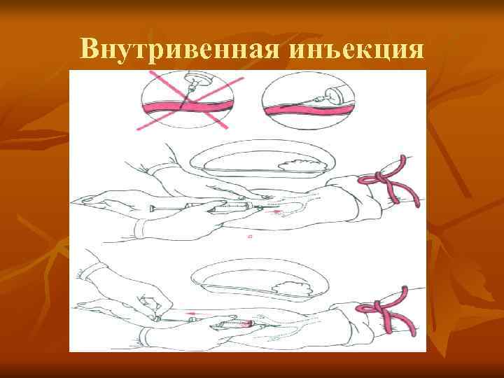 Внутривенная инъекция 