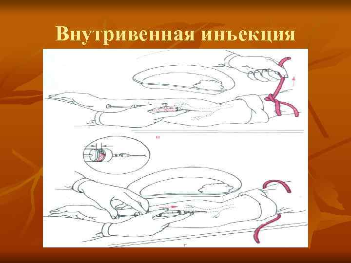 Варианты внутривенных инъекций