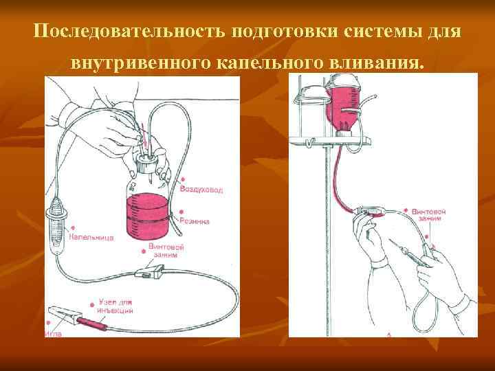 Заполнение системы. Система для внутривенного переливания крови схема. Сбор капельницы для в/в капельного введения алгоритм. Система для внутривенного капельного вливания. Подготовка системы для внутривенного капельного вливания.