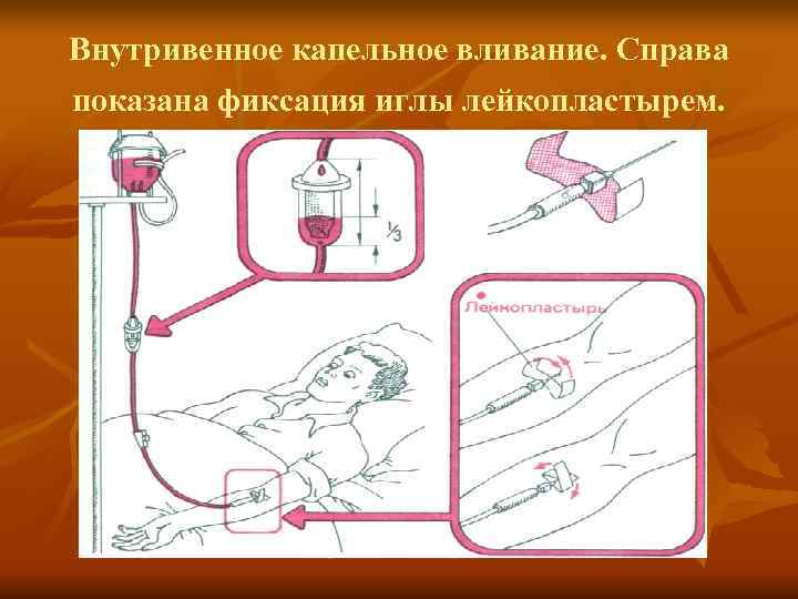 Фото подкожной инъекции в плечо с описанием техника постановки