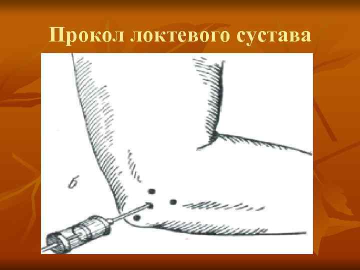 Прокол локтевого сустава 