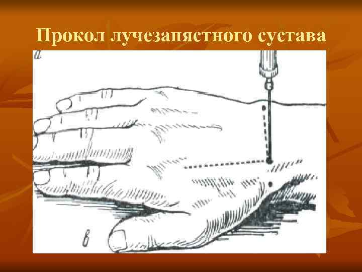 Прокол лучезапястного сустава 