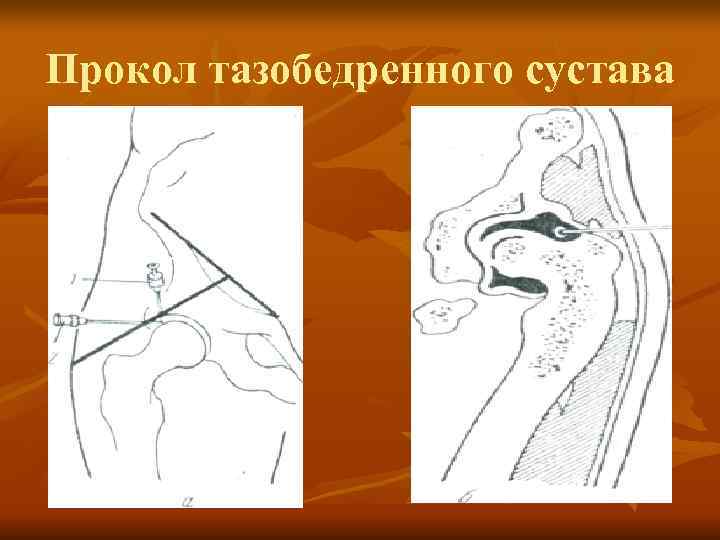 Прокол тазобедренного сустава 