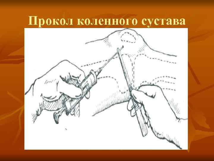 Прокол коленного сустава 