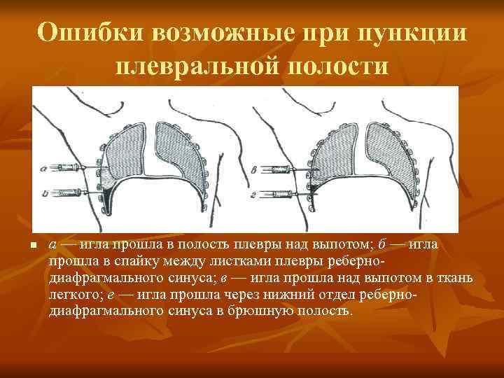 Плевральная полость фото