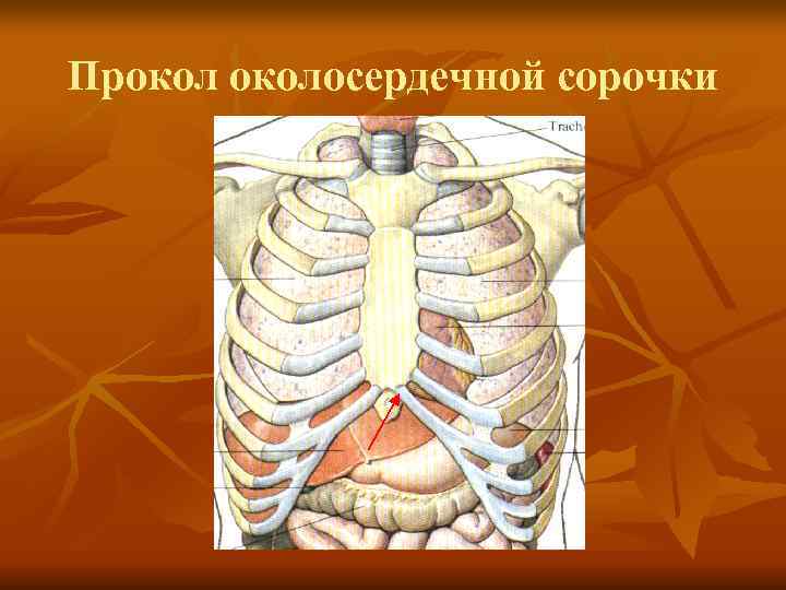 Проколосердечной сорочки 