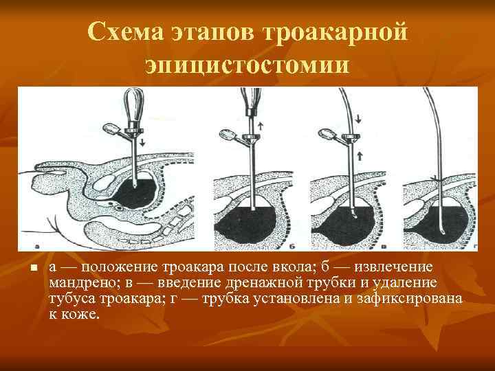   Схема этапов троакарной   эпицистостомии n  а — положение троакара