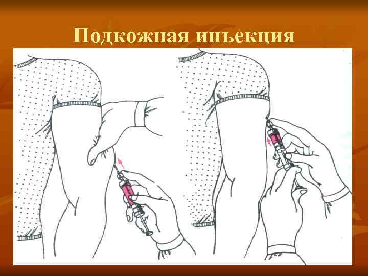 Подкожная инъекция 