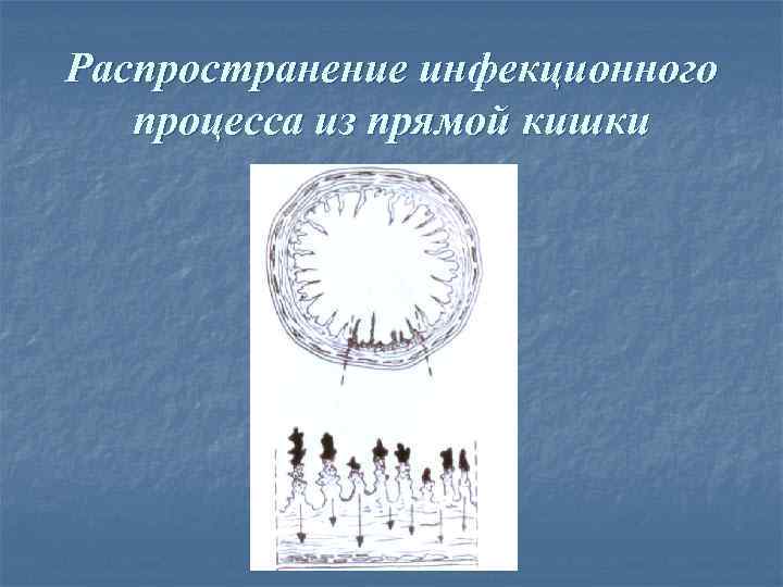 Распространение инфекционного  процесса из прямой кишки 