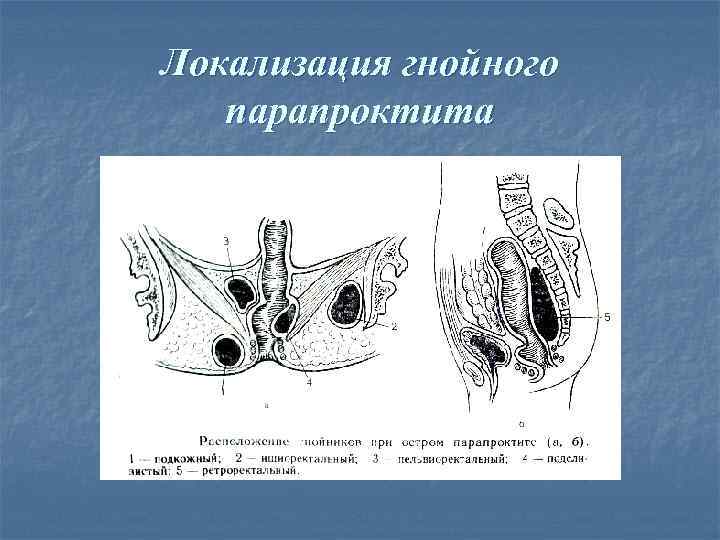Локализация гнойного  парапроктита 