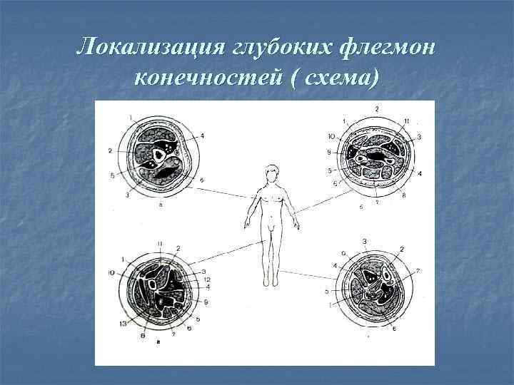 Локализация глубоких флегмон конечностей ( схема) 