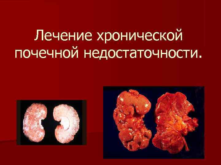  Лечение хронической почечной недостаточности. 