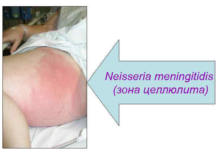 Neisseria meningitidis  (зона целлюлита) 