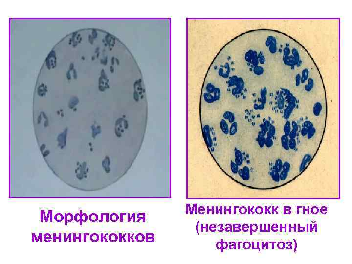     Менингококк в гное Морфология   (незавершенный менингококков  фагоцитоз)