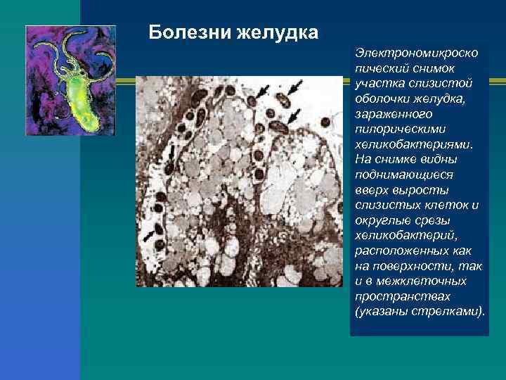 Болезни желудка    Электрономикроско    пический снимок   