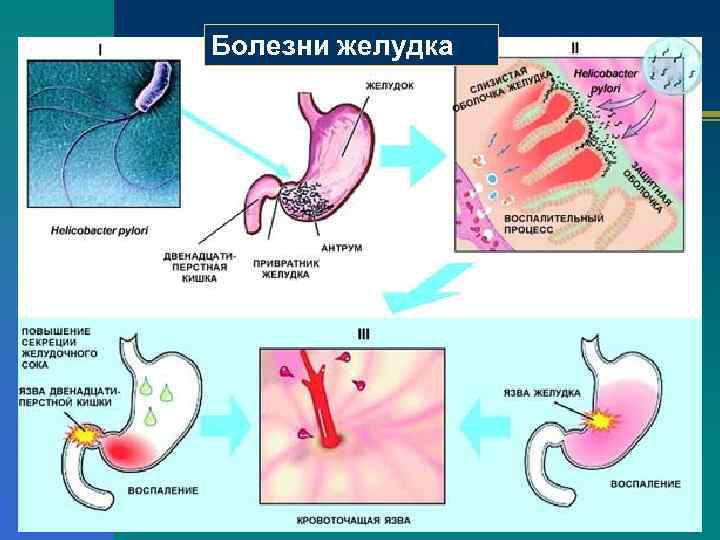 Болезни желудка 