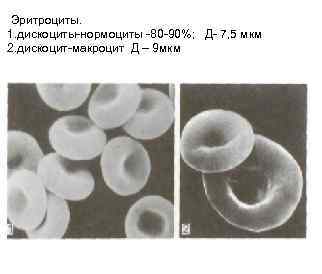 Эритроциты. 1. дискоциты-нормоциты -80 -90%; Д- 7, 5 мкм 2. дискоцит-макроцит Д – 9 Эритроциты. 1. дискоциты-нормоциты -80 -90%; Д- 7, 5 мкм 2. дискоцит-макроцит Д – 9