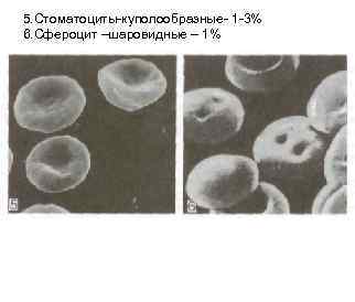5. Стоматоциты-куполообразные- 1 -3% 6. Сфероцит –шаровидные – 1% 5. Стоматоциты-куполообразные- 1 -3% 6. Сфероцит –шаровидные – 1%