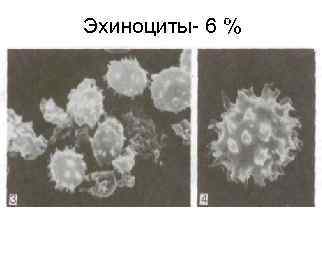 Эхиноциты- 6 % Эхиноциты- 6 %