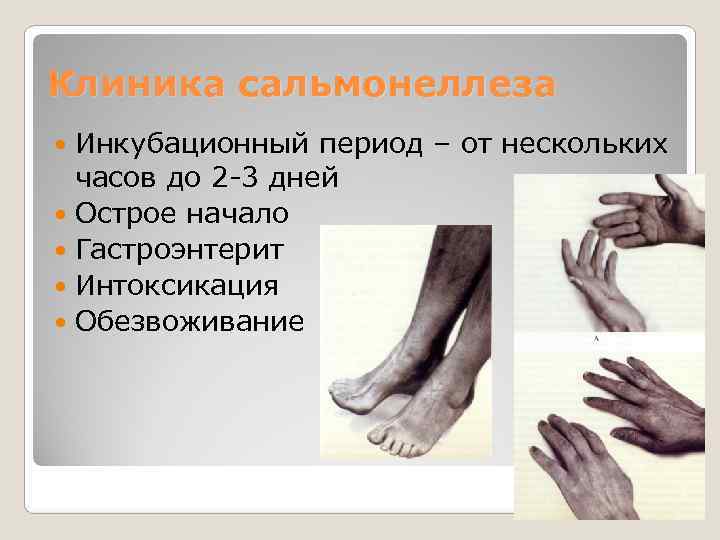 Клиника сальмонеллеза  Инкубационный период – от нескольких  часов до 2 -3 дней