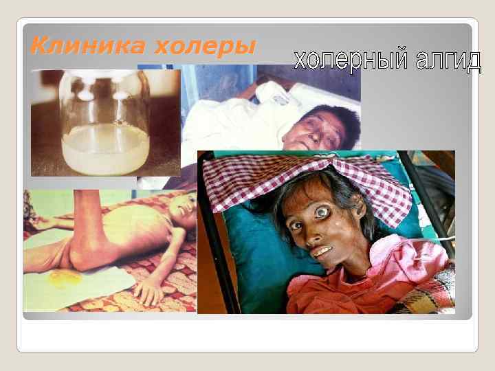 Клиника холеры 