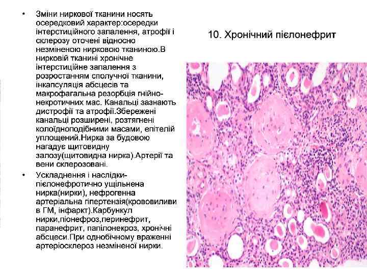 Хронічний пієлонефрит • Склеротичні зміни сполучаються з ексудативно-некротичними. В стінці мисок та чашок розвивається