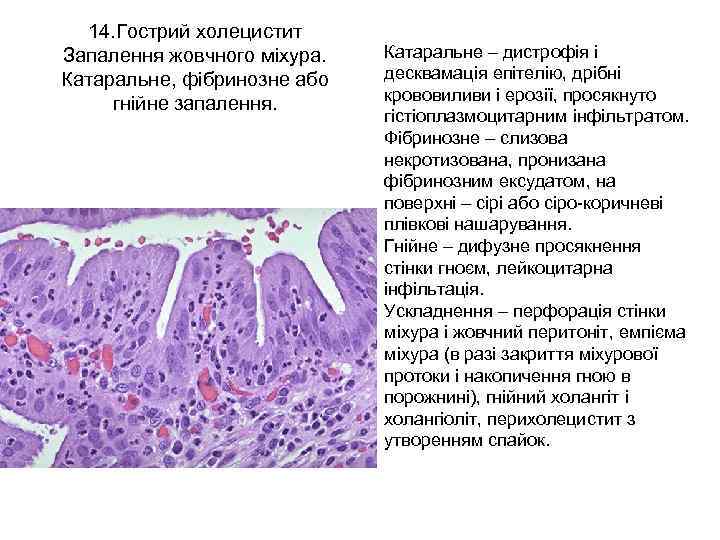 14. Гострий холецистит Запалення жовчного міхура. Катаральне, фібринозне або гнійне запалення. Катаральне – дистрофія