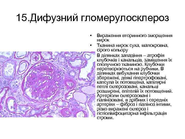 15. Дифузний гломерулосклероз • • • Вираження вторинного зморщення нирок Тканина нирок суха, малокровна,