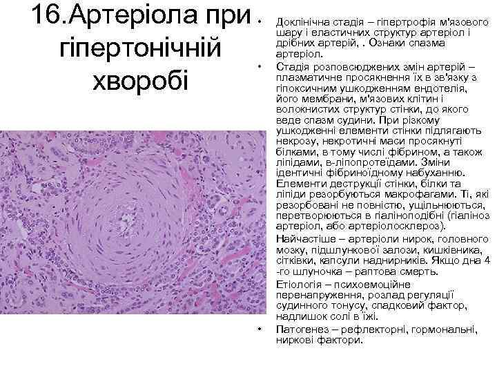 16. Артеріола при • гіпертонічній • хворобі • • • Доклінічна стадія – гіпертрофія