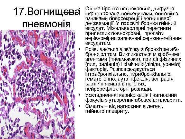  • Стінка бронха повнокровна, дифузно інфільтрована лейкоцитами, епітелій з ознаками гіперсекреції і вогнищевої