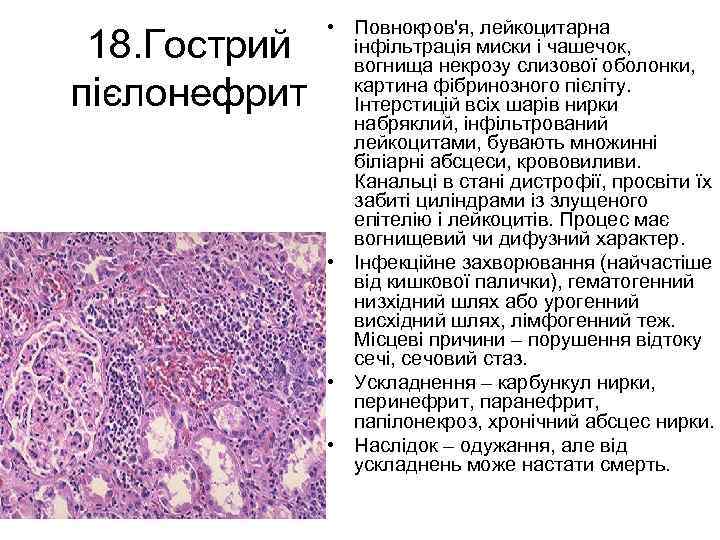 18. Гострий пієлонефрит • Повнокров'я, лейкоцитарна інфільтрація миски і чашечок, вогнища некрозу слизової оболонки,