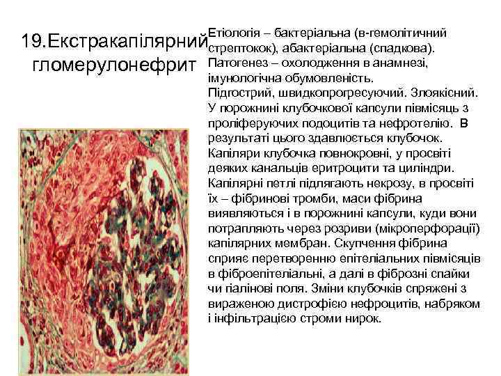 Етіологія – бактеріальна (в-гемолітичний 19. Екстракапілярнийстрептокок), абактеріальна (спадкова). гломерулонефрит Патогенез – охолодження в анамнезі,