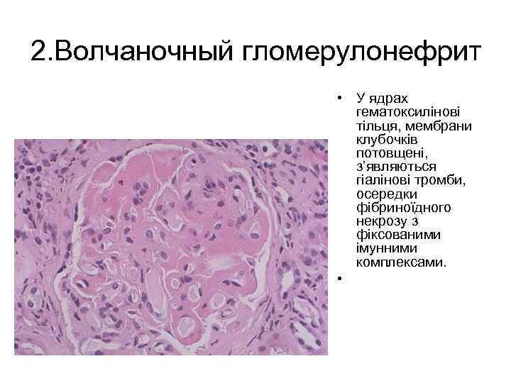 2. Волчаночный гломерулонефрит • У ядрах гематоксилінові тільця, мембрани клубочків потовщені, з’являються гіалінові тромби,