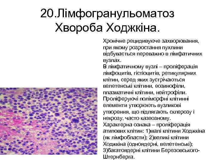 20. Лімфогранульоматоз Хвороба Ходжкіна. Хронічне рецидивуюче захворювання, при якому розростання пухлини відбувається переважно в