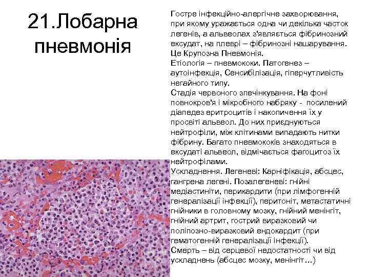 21. Лобарна пневмонія Гостре інфекційно-алергічне захворювання, при якому уражається одна чи декілька часток легенів,