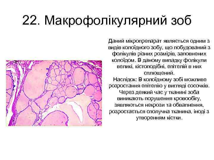 22. Макрофолікулярний зоб Даний мікропрепарат являється одним з видів колоїдного зобу, що побудований з