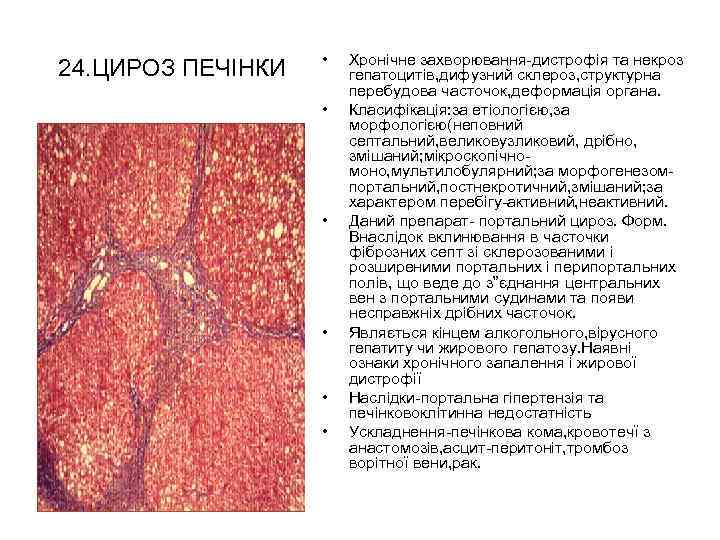 24. ЦИРОЗ ПЕЧІНКИ • • • Хронічне захворювання-дистрофія та некроз гепатоцитів, дифузний склероз, структурна